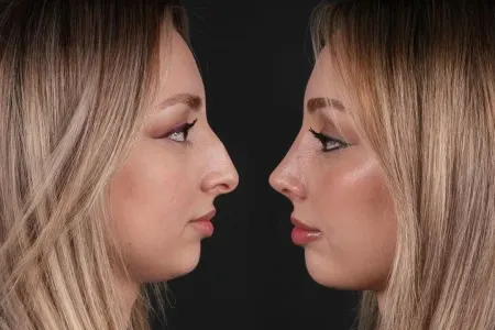 Bu qadınlara burun əməliyyatı qadağandır - SƏBƏB