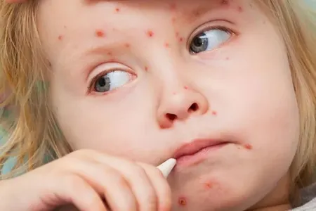 Bu xəstəlik uşaqlarda kütləvi ölümə səbəb olur