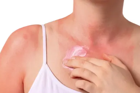 Bu saatlarda günəş altında qalmayın