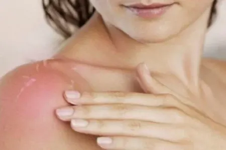 Günəş yanıqlarına qarşı - əsas vasitələr hansılardır?