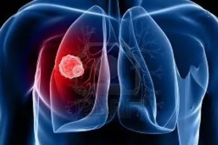 Ağciyər xərçənginin ilk əlaməti yanaqda görünə bilər - – Gecikməyin, aynaya baxın!