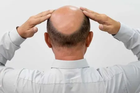 Saç tökülməsinə son - Çarəsi tapıldı