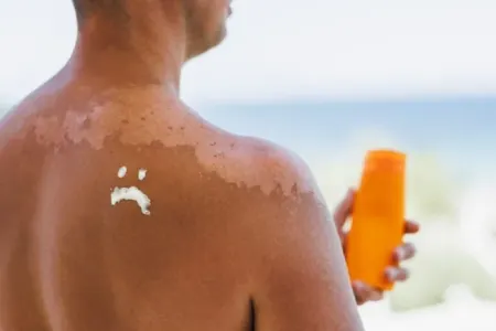 Dəridəki ləkələrə diqqət - – günəş yanığı illər sonra dəri xərçəngi yarada bilər!