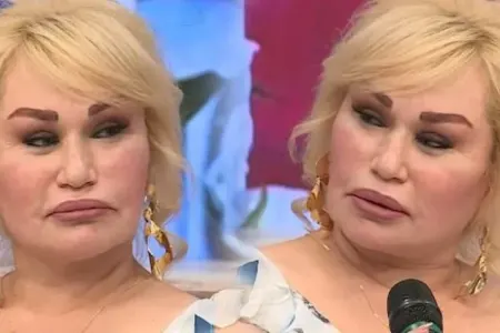 Plastik əməliyyat etdirən Sevdanın üzü əyildi - VİDEO