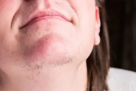 Bu qidalar qadınlarda tüklənməyə səbəb olur