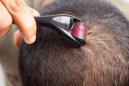 Baş dərisini "deşmək" saç çıxardır?