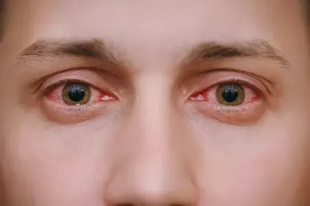 Yay aylarında göz sağlamlığınıza - DİQQƏT EDİN!