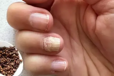 Dırnaq göbələyinə iki sadə məhsulla - TƏBİİ ÇARƏ