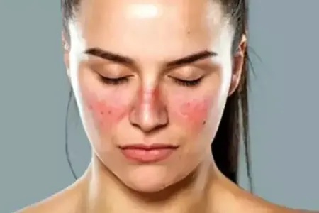 Üzdəki ləkələr lupus əlaməti - OLA BİLƏR