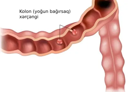 Bu qidalar bağırsaq xərçənginə səbəb olur - ADLAR