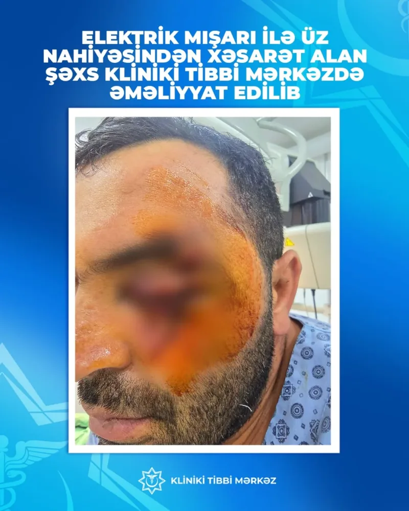 Bakıda DƏHŞƏT: laqunda kişinin üzünü kəsdi