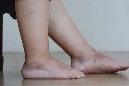 Bədəndə şişkinlik bu 3 səbəbdən ola bilər – Kardioloq xəbərdarlıq edir