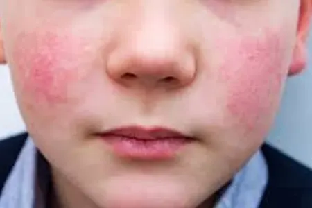 Uşaqlar arasında yeni virus yayıldı: Nələrə diqqət edək?