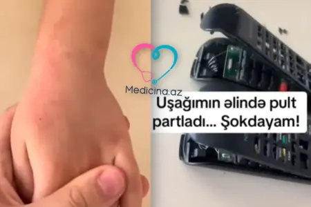 Bakıda azyaşlının əlində pult partladı