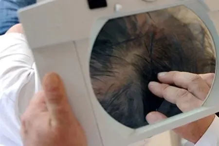 Saç əkdirmə əməliyyatından sonra öldü