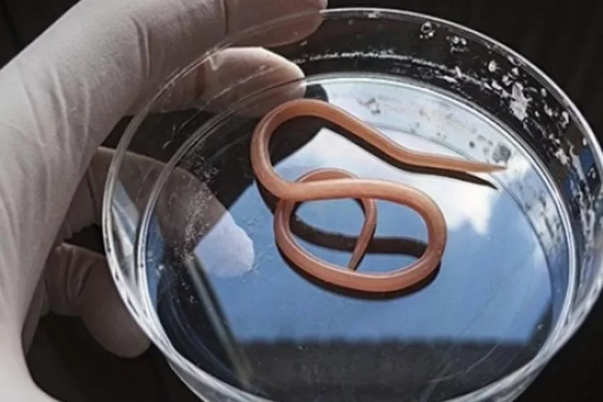 35 yaşlı kişinin gözündən qurd ÇIXDI