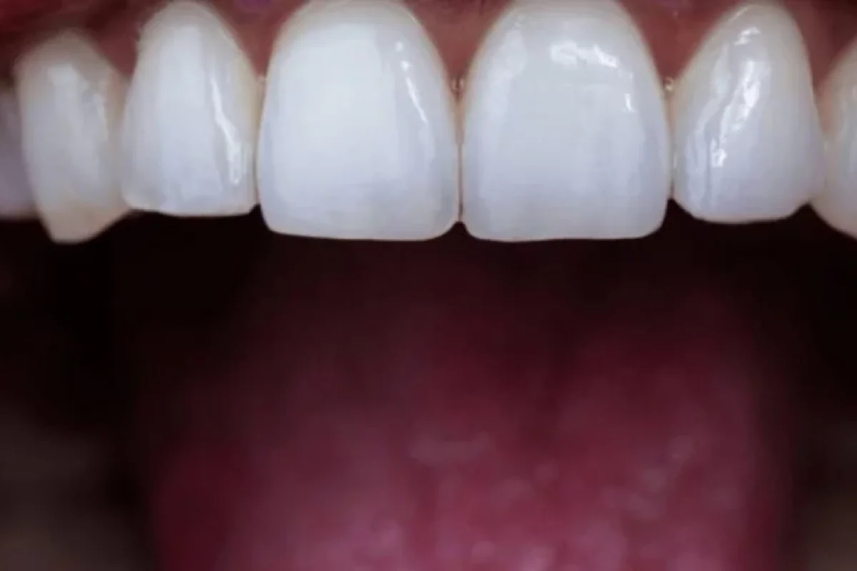 Bu vərdişlər dişlərinizi məhv edir - Açıqlama