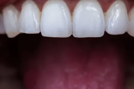 Bu vərdişlər dişlərinizi məhv edir - Açıqlama