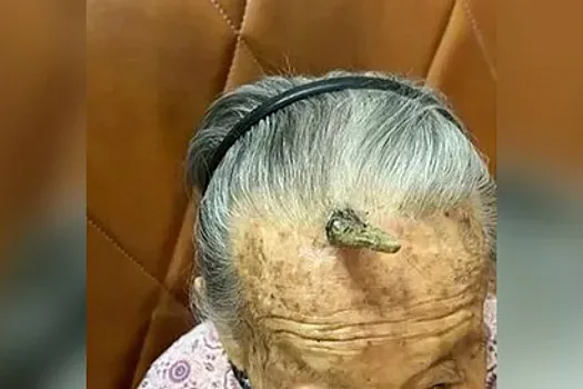 Qadın alnındakı buynuzu kəsmək istədi, ölümdən döndü – - FOTO