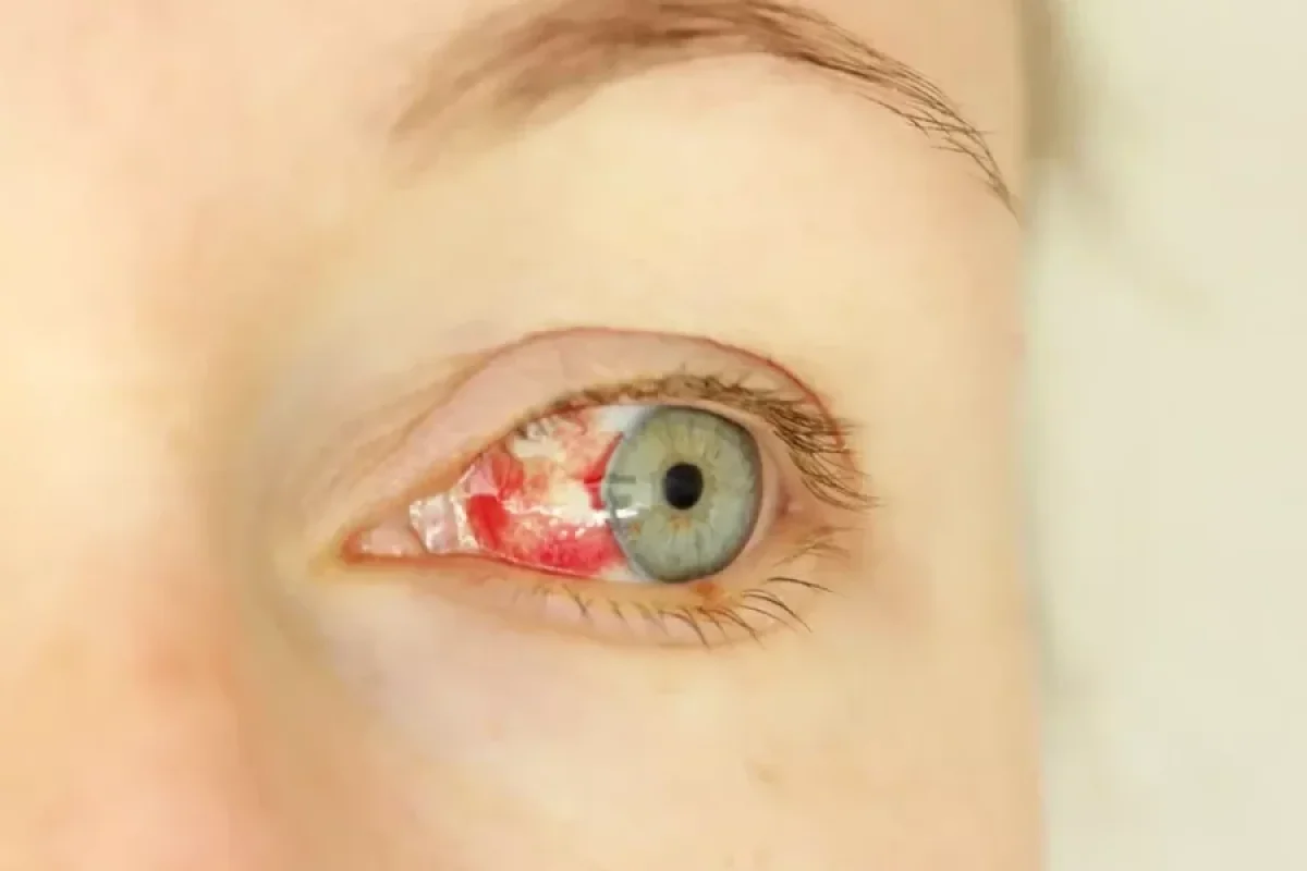 Göz qanaması ilə başlayan - gizli virus yayılır