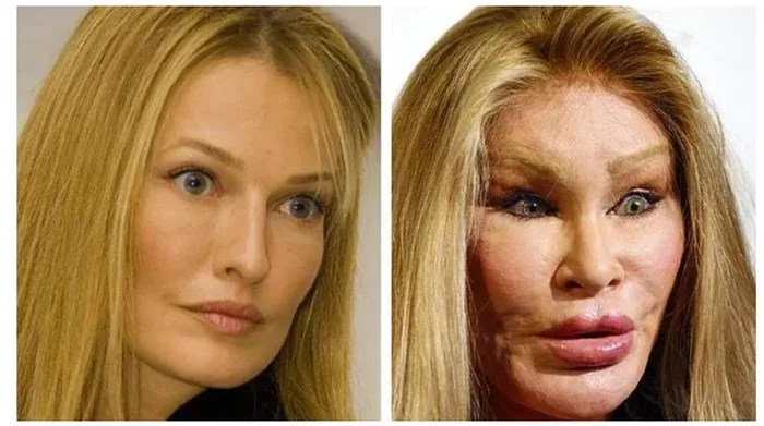 Plastik əməliyyatın qurbanı olan məşhurlar - Fotolar