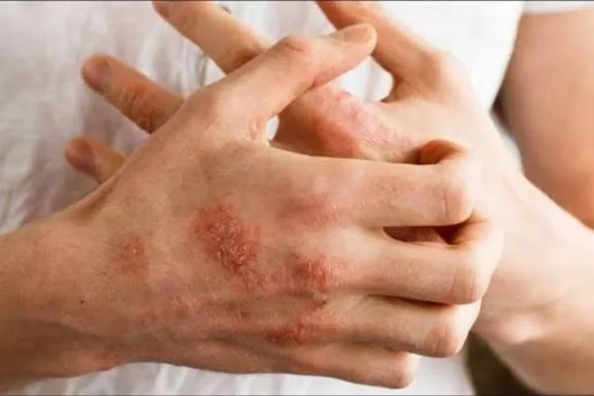 Bu xəstəliyə diqqət: Hamı onu adi allergiya bilir, amma həyatı məhv edir