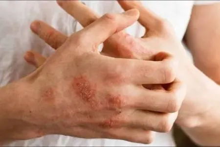 Bu xəstəliyə diqqət: Hamı onu adi allergiya bilir, amma həyatı məhv edir