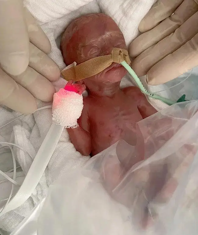Tibbi möcüzə: həkimlər 300 qramlıq körpənin həyatını xilas etdilər – Foto