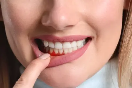 Sadə görünür, amma təhlükəlidir - Diş əti qanaması nəyin xəbəridir?