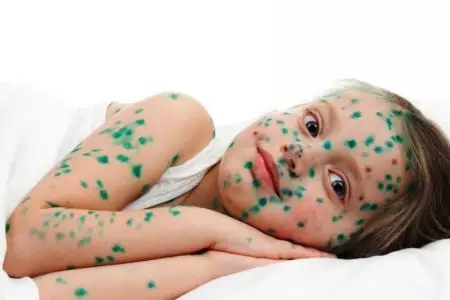 Ölkədə suçiçəyi yayılır? – Rəsmi AÇIQLAMA 