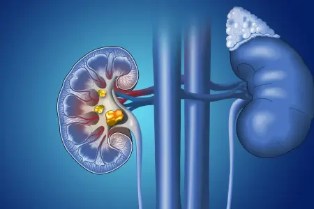 Yemək masanızdakı bu təhlükə böyrəklərinizi məhv edir