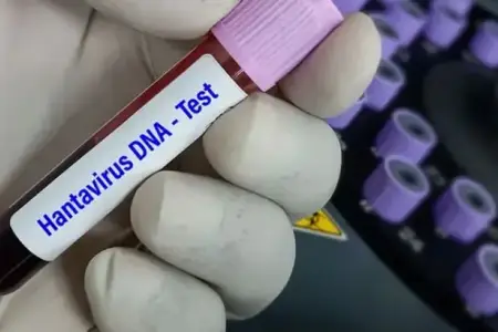 ÜST-ün hantavirusla bağlı açıqlaması: Yoluxma hallarının sayı arta bilər