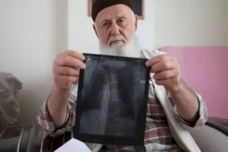 Siqaretə görə 3 barmağını itirdi - FOTO