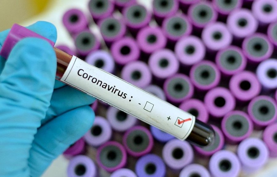 Azərbaycanda 1717 nəfər koronavirusa yoluxub, 1221-i sağalıb, 22 nəfəri ölüb