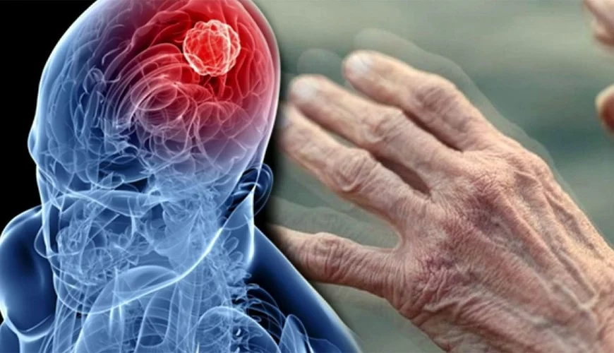 Parkinson xəstəliyinin genetik səbəbi tapıldı 