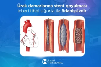 Ürək damarlarına stentin qoyulması pulsuzdur - İcbari tibbi sığorta